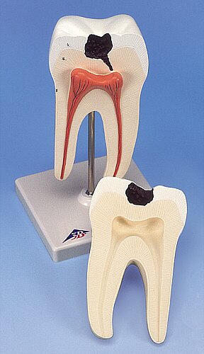 Molar inferior con 2 ra�ces  D10/4