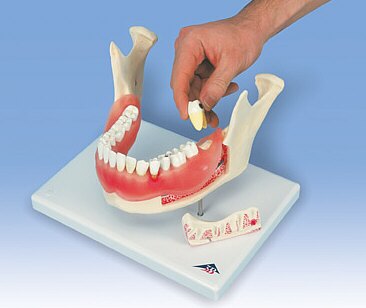 Afecci�n dental, a 2 aumentos, de 21 piezas D26